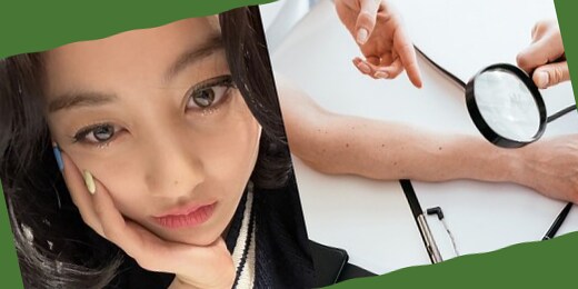 手背 痣